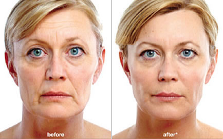 Before and After use of the Nu-Derm System + tretinton