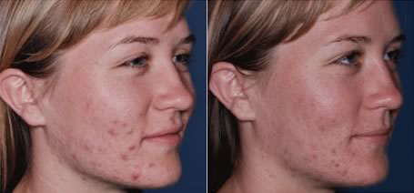 Obagi Clenziderm - before and after 