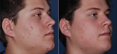 Obagi Clenziderm - before and after 
